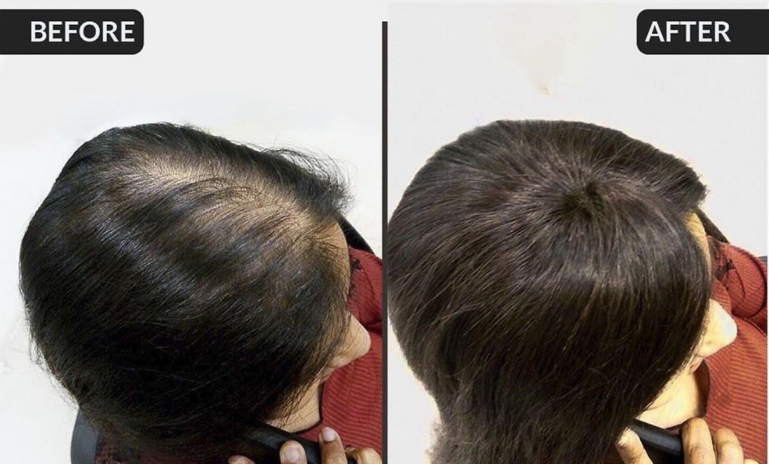 Frequently Asked Questions About Hair Toppers Answered