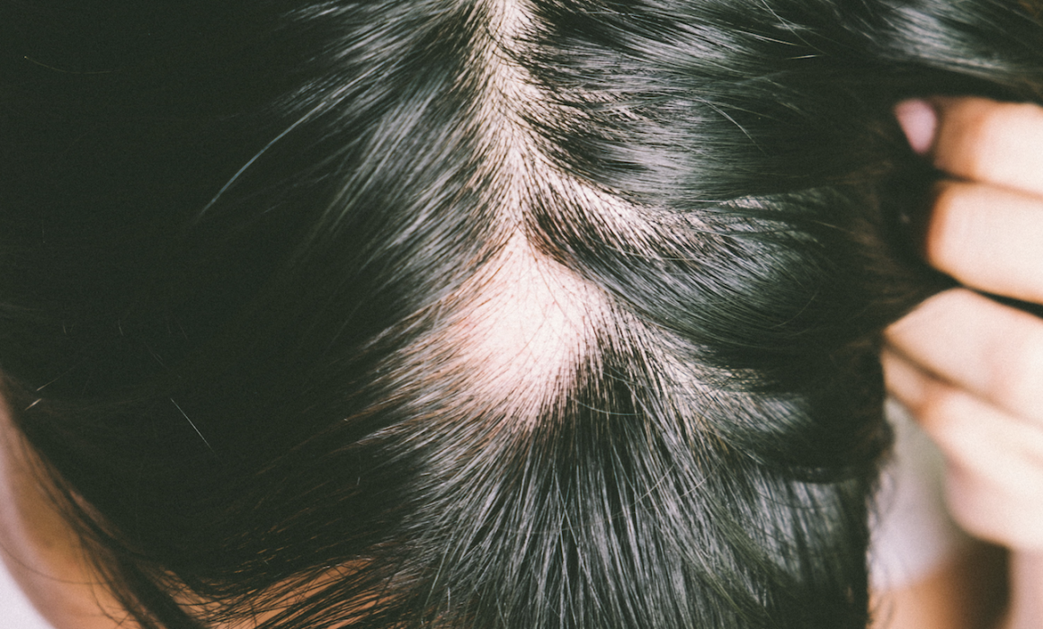 The different types of alopecia with symptoms, causes, and cures